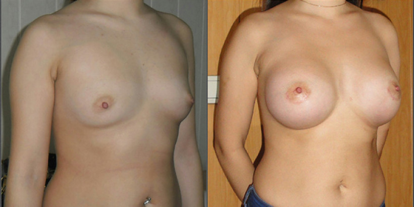 breast05-02